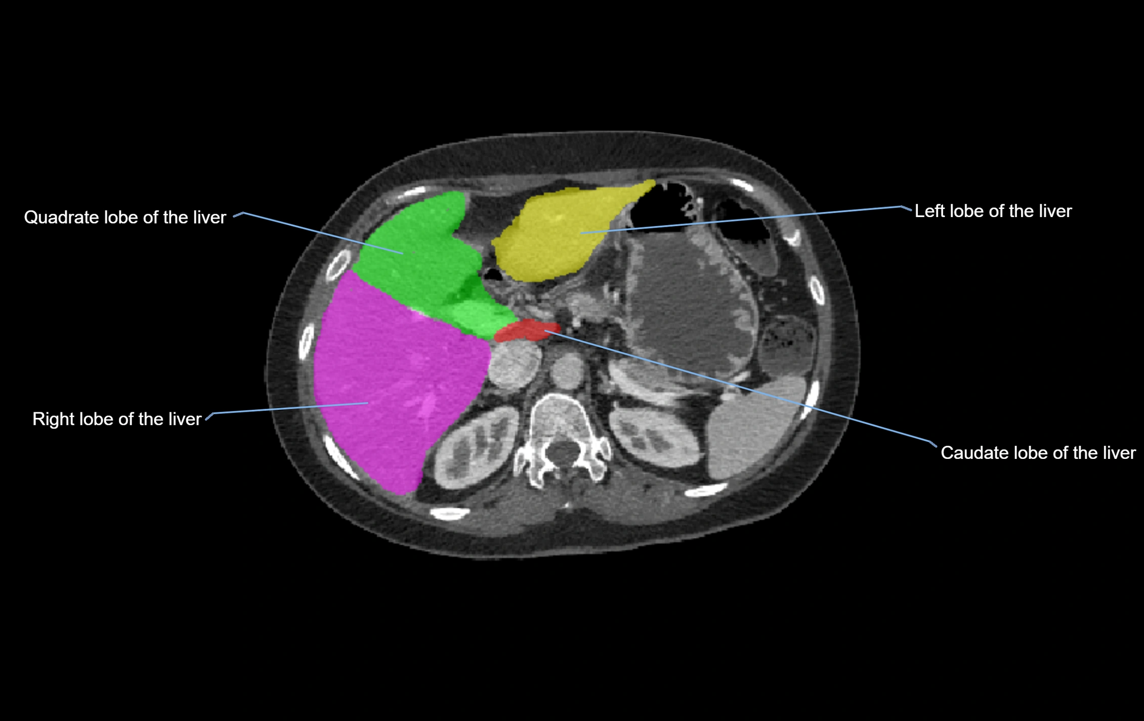 CT lliver lobes axial cross sectional anatomy labelled image -00045.webp